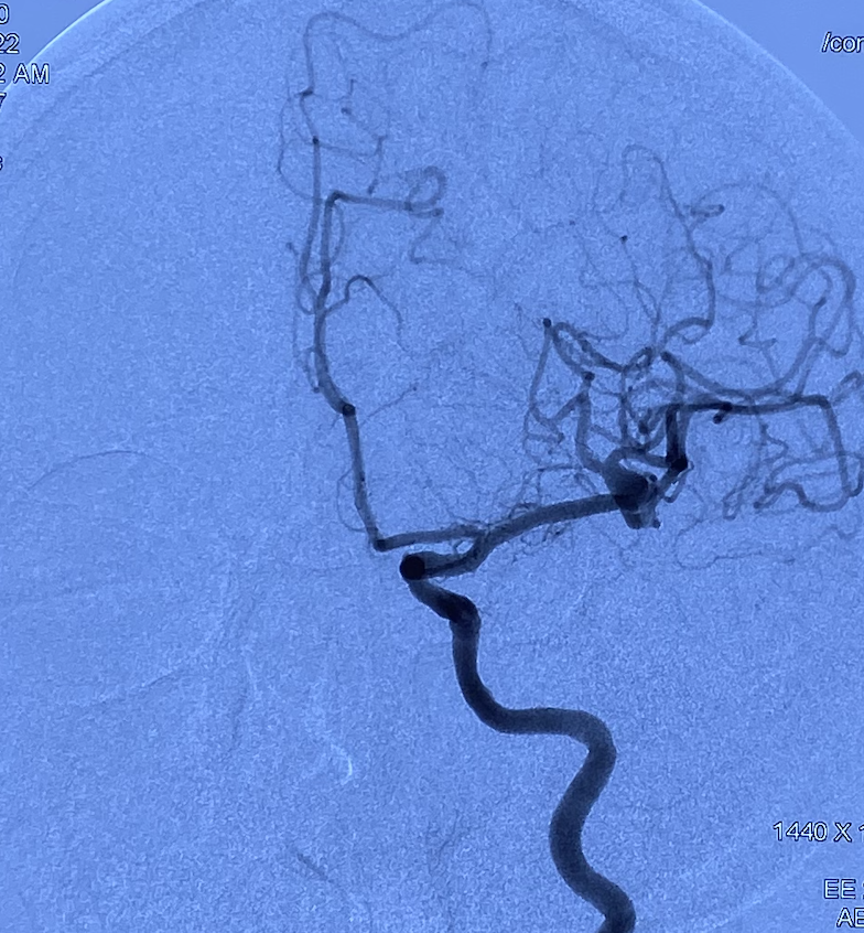 什么达医畅疗·第一期 ｜ 畅医达（Choydar）17小系统血流导向装置治疗大脑中动脉动脉瘤两例_https://www.jmylbn.com_新闻资讯_第7张