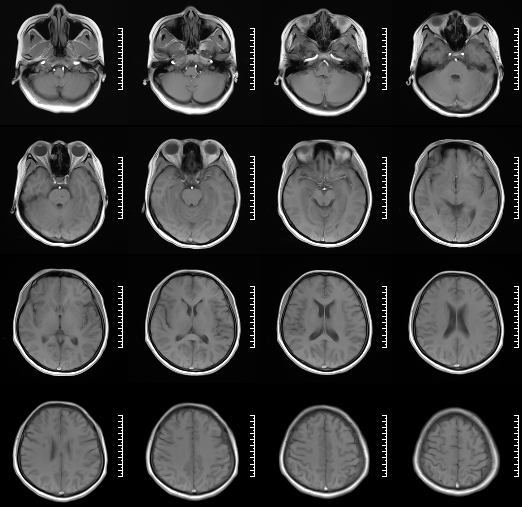 什么达医畅疗·第二期 ｜ 畅医达（Choydar）17小系统血流导向装置经桡治疗大脑中动脉动脉瘤_https://www.jmylbn.com_新闻资讯_第5张