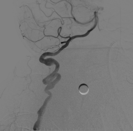 什么达医畅疗·第二期 ｜ 畅医达（Choydar）17小系统血流导向装置经桡治疗大脑中动脉动脉瘤_https://www.jmylbn.com_新闻资讯_第30张