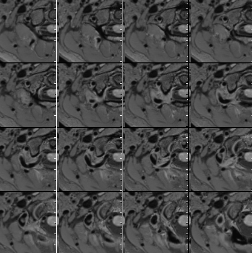 什么达医畅疗·第二期 ｜ 畅医达（Choydar）17小系统血流导向装置经桡治疗大脑中动脉动脉瘤_https://www.jmylbn.com_新闻资讯_第13张