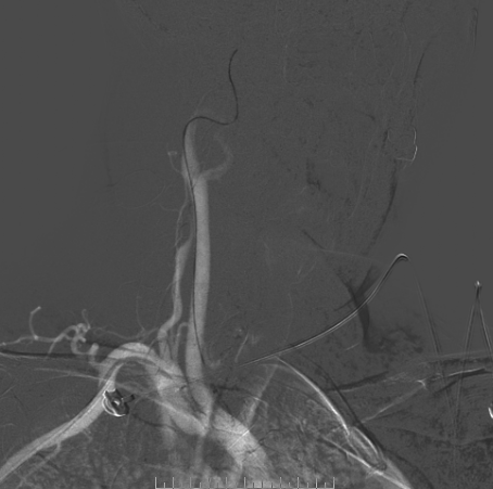 什么达医畅疗·第二期 ｜ 畅医达（Choydar）17小系统血流导向装置经桡治疗大脑中动脉动脉瘤_https://www.jmylbn.com_新闻资讯_第37张