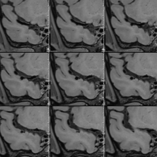什么达医畅疗·第二期 ｜ 畅医达（Choydar）17小系统血流导向装置经桡治疗大脑中动脉动脉瘤_https://www.jmylbn.com_新闻资讯_第11张