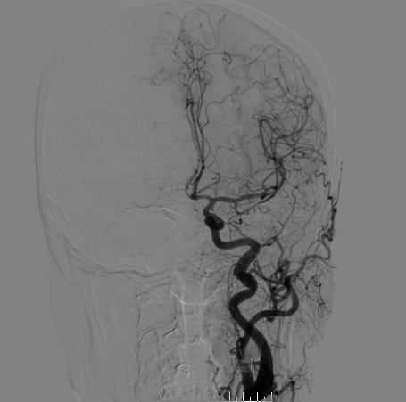 什么达医畅疗·第二期 ｜ 畅医达（Choydar）17小系统血流导向装置经桡治疗大脑中动脉动脉瘤_https://www.jmylbn.com_新闻资讯_第19张