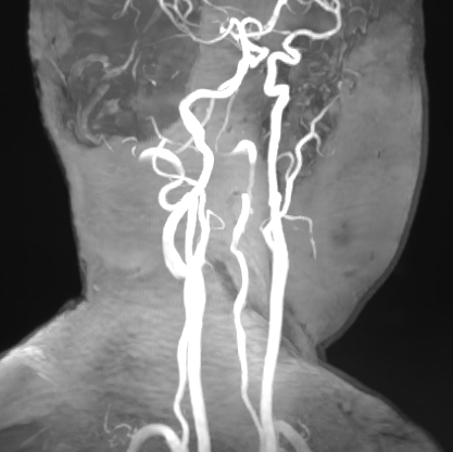 什么达医畅疗·第二期 ｜ 畅医达（Choydar）17小系统血流导向装置经桡治疗大脑中动脉动脉瘤_https://www.jmylbn.com_新闻资讯_第9张