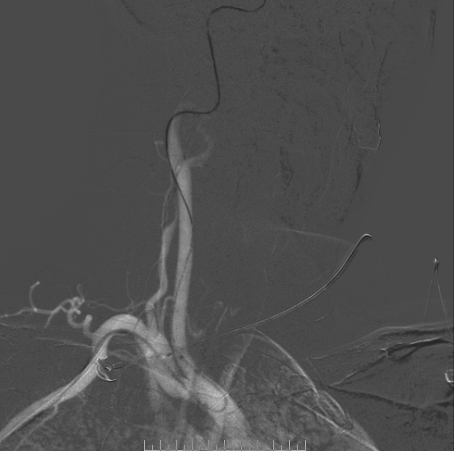 什么达医畅疗·第二期 ｜ 畅医达（Choydar）17小系统血流导向装置经桡治疗大脑中动脉动脉瘤_https://www.jmylbn.com_新闻资讯_第38张