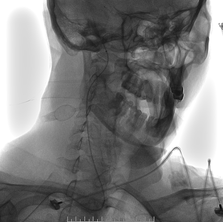 什么达医畅疗·第二期 ｜ 畅医达（Choydar）17小系统血流导向装置经桡治疗大脑中动脉动脉瘤_https://www.jmylbn.com_新闻资讯_第39张