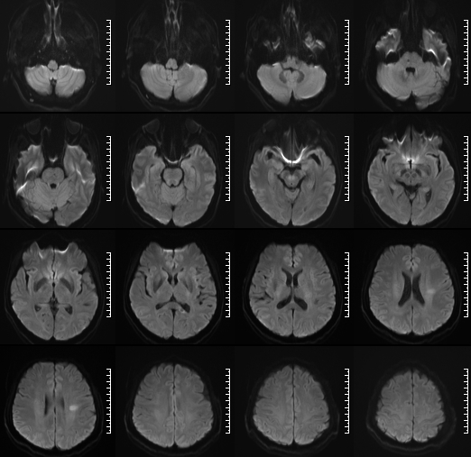 什么达医畅疗·第二期 ｜ 畅医达（Choydar）17小系统血流导向装置经桡治疗大脑中动脉动脉瘤_https://www.jmylbn.com_新闻资讯_第3张