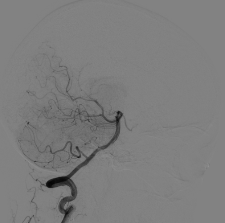 什么达医畅疗·第二期 ｜ 畅医达（Choydar）17小系统血流导向装置经桡治疗大脑中动脉动脉瘤_https://www.jmylbn.com_新闻资讯_第15张