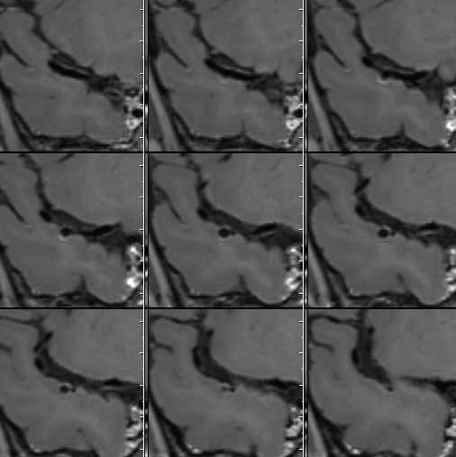 什么达医畅疗·第二期 ｜ 畅医达（Choydar）17小系统血流导向装置经桡治疗大脑中动脉动脉瘤_https://www.jmylbn.com_新闻资讯_第12张