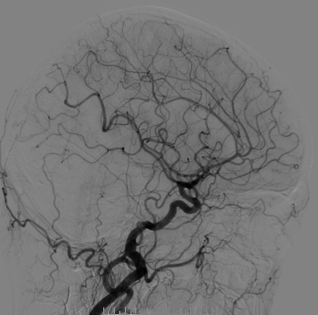 什么达医畅疗·第二期 ｜ 畅医达（Choydar）17小系统血流导向装置经桡治疗大脑中动脉动脉瘤_https://www.jmylbn.com_新闻资讯_第18张