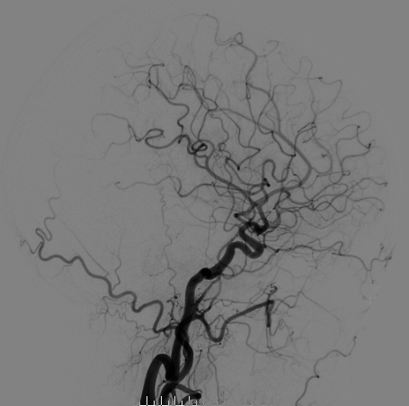 什么达医畅疗·第二期 ｜ 畅医达（Choydar）17小系统血流导向装置经桡治疗大脑中动脉动脉瘤_https://www.jmylbn.com_新闻资讯_第22张