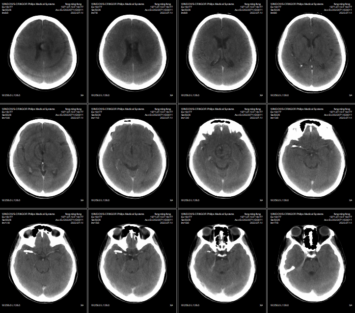 什么达医畅疗·第二期 ｜ 畅医达（Choydar）17小系统血流导向装置经桡治疗大脑中动脉动脉瘤_https://www.jmylbn.com_新闻资讯_第56张