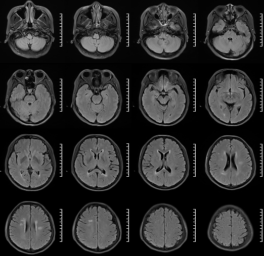 什么达医畅疗·第二期 ｜ 畅医达（Choydar）17小系统血流导向装置经桡治疗大脑中动脉动脉瘤_https://www.jmylbn.com_新闻资讯_第6张