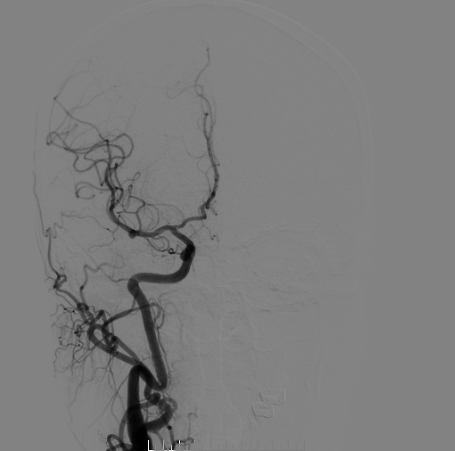 什么达医畅疗·第二期 ｜ 畅医达（Choydar）17小系统血流导向装置经桡治疗大脑中动脉动脉瘤_https://www.jmylbn.com_新闻资讯_第21张