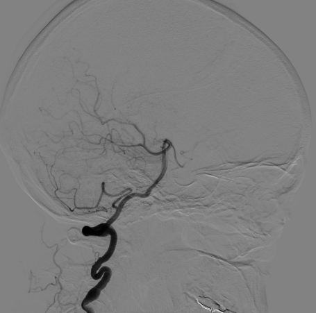 什么达医畅疗·第二期 ｜ 畅医达（Choydar）17小系统血流导向装置经桡治疗大脑中动脉动脉瘤_https://www.jmylbn.com_新闻资讯_第28张