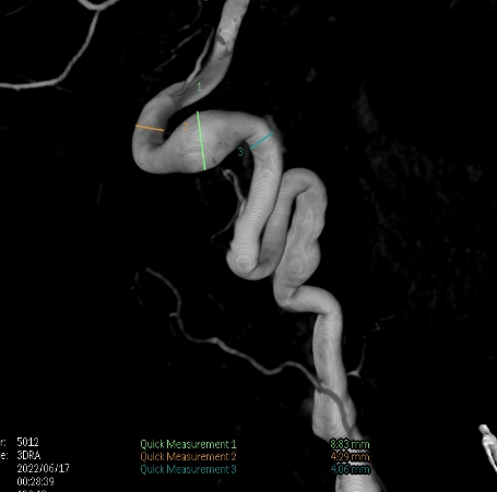 什么达医畅疗·第二期 ｜ 畅医达（Choydar）17小系统血流导向装置经桡治疗大脑中动脉动脉瘤_https://www.jmylbn.com_新闻资讯_第31张