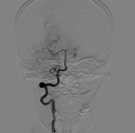 什么达医畅疗·第二期 ｜ 畅医达（Choydar）17小系统血流导向装置经桡治疗大脑中动脉动脉瘤_https://www.jmylbn.com_新闻资讯_第29张