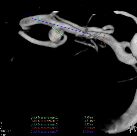 什么达医畅疗·第二期 ｜ 畅医达（Choydar）17小系统血流导向装置经桡治疗大脑中动脉动脉瘤_https://www.jmylbn.com_新闻资讯_第26张