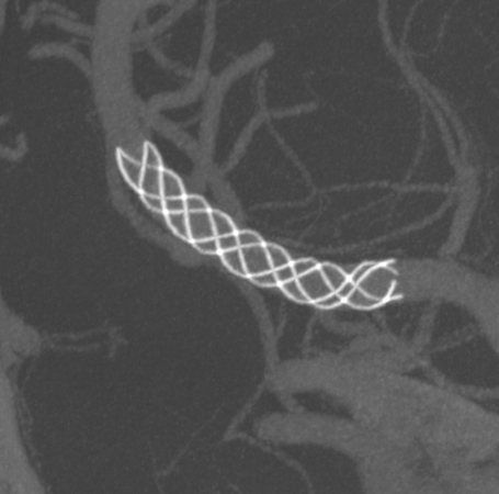 什么达医畅疗·第二期 ｜ 畅医达（Choydar）17小系统血流导向装置经桡治疗大脑中动脉动脉瘤_https://www.jmylbn.com_新闻资讯_第50张
