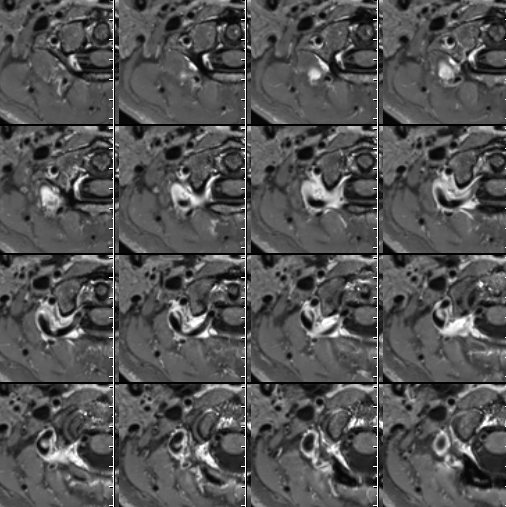 什么达医畅疗·第二期 ｜ 畅医达（Choydar）17小系统血流导向装置经桡治疗大脑中动脉动脉瘤_https://www.jmylbn.com_新闻资讯_第14张