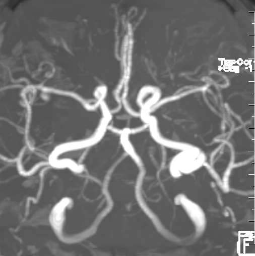 什么达医畅疗·第二期 ｜ 畅医达（Choydar）17小系统血流导向装置经桡治疗大脑中动脉动脉瘤_https://www.jmylbn.com_新闻资讯_第8张
