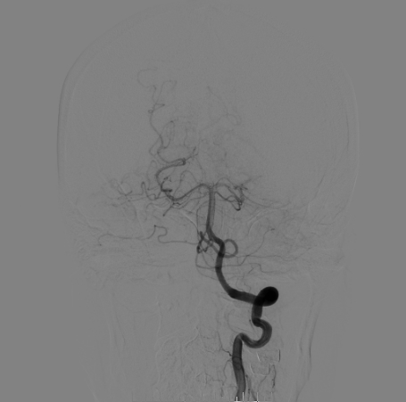 什么达医畅疗·第二期 ｜ 畅医达（Choydar）17小系统血流导向装置经桡治疗大脑中动脉动脉瘤_https://www.jmylbn.com_新闻资讯_第16张