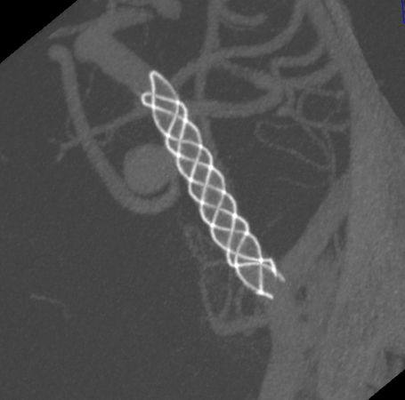 什么达医畅疗·第二期 ｜ 畅医达（Choydar）17小系统血流导向装置经桡治疗大脑中动脉动脉瘤_https://www.jmylbn.com_新闻资讯_第49张