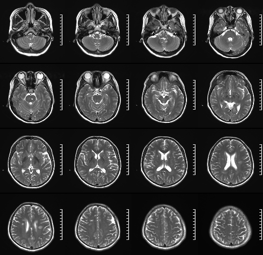 什么达医畅疗·第二期 ｜ 畅医达（Choydar）17小系统血流导向装置经桡治疗大脑中动脉动脉瘤_https://www.jmylbn.com_新闻资讯_第4张