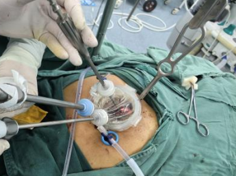 外科拉勾怎么拉【赣医精术】“钥匙孔”里的高精操作！我院胸外科成功开展全市首例胸骨拉钩辅助剑突下单孔全胸腺切除术_https://www.jmylbn.com_新闻资讯_第10张