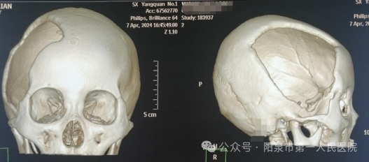 Optima什么医疗【特色医疗】我院神经外科成功行PEEK-OPTIMA®颅骨嵌入式个体化修补术_https://www.jmylbn.com_新闻资讯_第5张