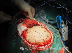 Optima什么医疗【特色医疗】我院神经外科成功行PEEK-OPTIMA®颅骨嵌入式个体化修补术_https://www.jmylbn.com_新闻资讯_第7张