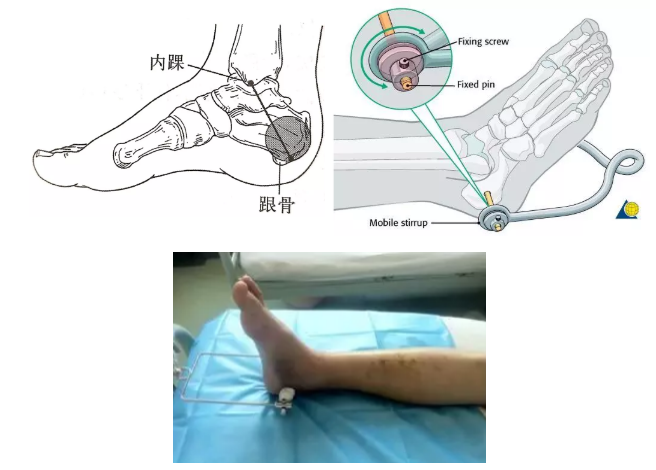 下肢牵引带怎么用带你认识骨科牵引术_https://www.jmylbn.com_新闻资讯_第7张
