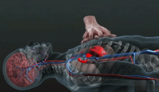 cpr按压板怎么用【健康知识宣传】关键时刻能救命！说一说心肺复苏急救法_https://www.jmylbn.com_新闻资讯_第2张