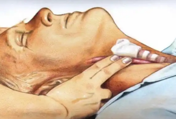 cpr按压板怎么用【健康知识宣传】关键时刻能救命！说一说心肺复苏急救法_https://www.jmylbn.com_新闻资讯_第3张