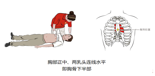 cpr按压板怎么用【健康知识宣传】关键时刻能救命！说一说心肺复苏急救法_https://www.jmylbn.com_新闻资讯_第6张
