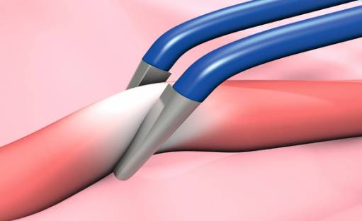 为什么没有双极电刀电外科干货｜双极电刀的安全使用_https://www.jmylbn.com_新闻资讯_第6张