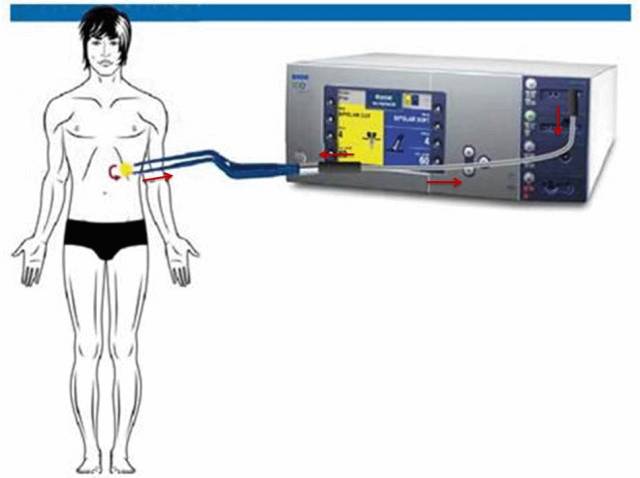 为什么没有双极电刀电外科干货｜双极电刀的安全使用_https://www.jmylbn.com_新闻资讯_第3张