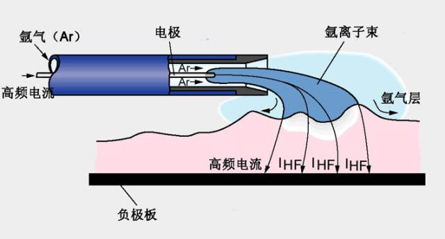 一次性氩气电极是什么医加百科 ｜ 氩气刀的组成与优势_https://www.jmylbn.com_新闻资讯_第2张