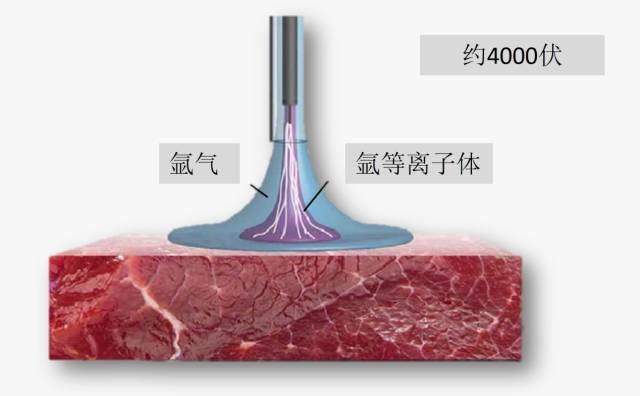 一次性氩气电极是什么医加百科 ｜ 氩气刀的组成与优势_https://www.jmylbn.com_新闻资讯_第1张