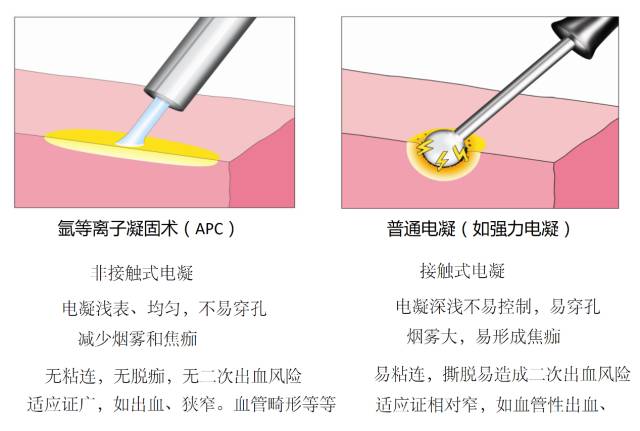 一次性氩气电极是什么医加百科 ｜ 氩气刀的组成与优势_https://www.jmylbn.com_新闻资讯_第8张