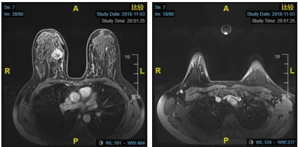 乳腺cr是什么【乳腺癌疑难病例＂艾月谈＂ 】艾赫新双靶新辅助治疗HER2阳性乳腺癌4周期获CR、tpCR，疗效安全皆可得_https://www.jmylbn.com_新闻资讯_第2张