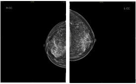 乳腺cr是什么【乳腺癌疑难病例＂艾月谈＂ 】艾赫新双靶新辅助治疗HER2阳性乳腺癌4周期获CR、tpCR，疗效安全皆可得_https://www.jmylbn.com_新闻资讯_第12张