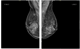 乳腺cr是什么【乳腺癌疑难病例＂艾月谈＂ 】艾赫新双靶新辅助治疗HER2阳性乳腺癌4周期获CR、tpCR，疗效安全皆可得_https://www.jmylbn.com_新闻资讯_第11张