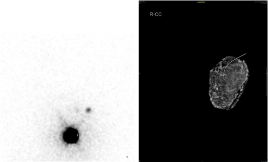 乳腺cr是什么【乳腺癌疑难病例＂艾月谈＂ 】艾赫新双靶新辅助治疗HER2阳性乳腺癌4周期获CR、tpCR，疗效安全皆可得_https://www.jmylbn.com_新闻资讯_第9张