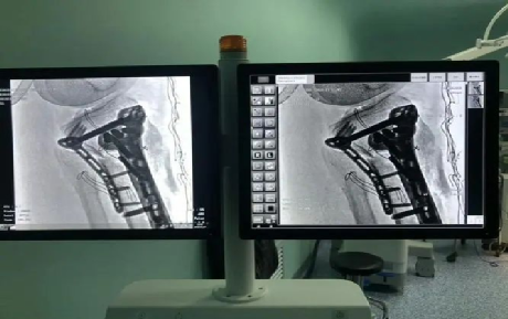 c臂机怎么上升C臂机透视中，防护的那些事！_https://www.jmylbn.com_新闻资讯_第10张