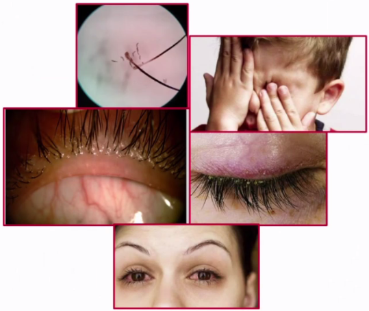 松油醇除螨湿巾,眼部清洁及药物涂抹等传统方式只能清除眼周表面螨虫