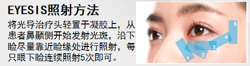 EYESIS强脉冲光操作方法