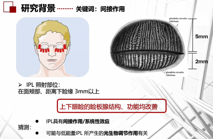 EYESIS强脉冲光可以依靠“打下治上”的间接方式治疗睑板腺功能障碍