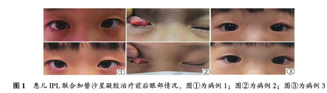 三个儿童霰粒肿案例分析