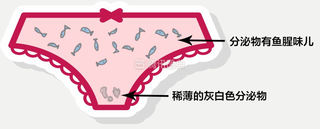 细菌性阴道炎这种表现与念珠菌(假丝酵母菌)感染的霉菌性阴道炎的